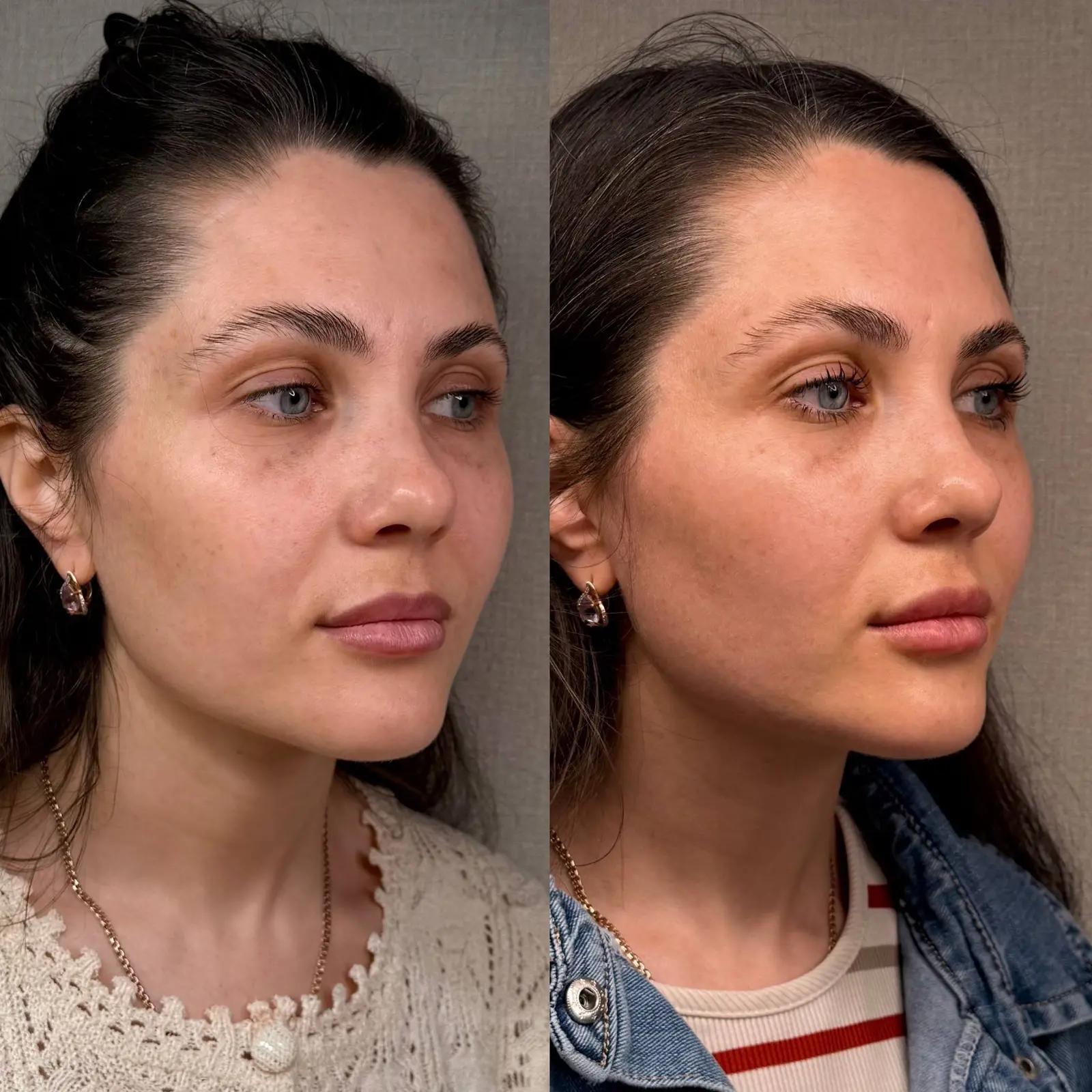 Клиническое изображение NAD+ Skin Matrix, кейс 1, ракурс 2